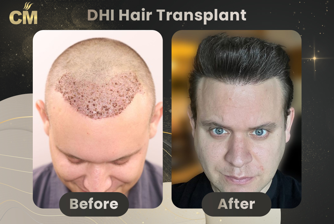 Before and After Result