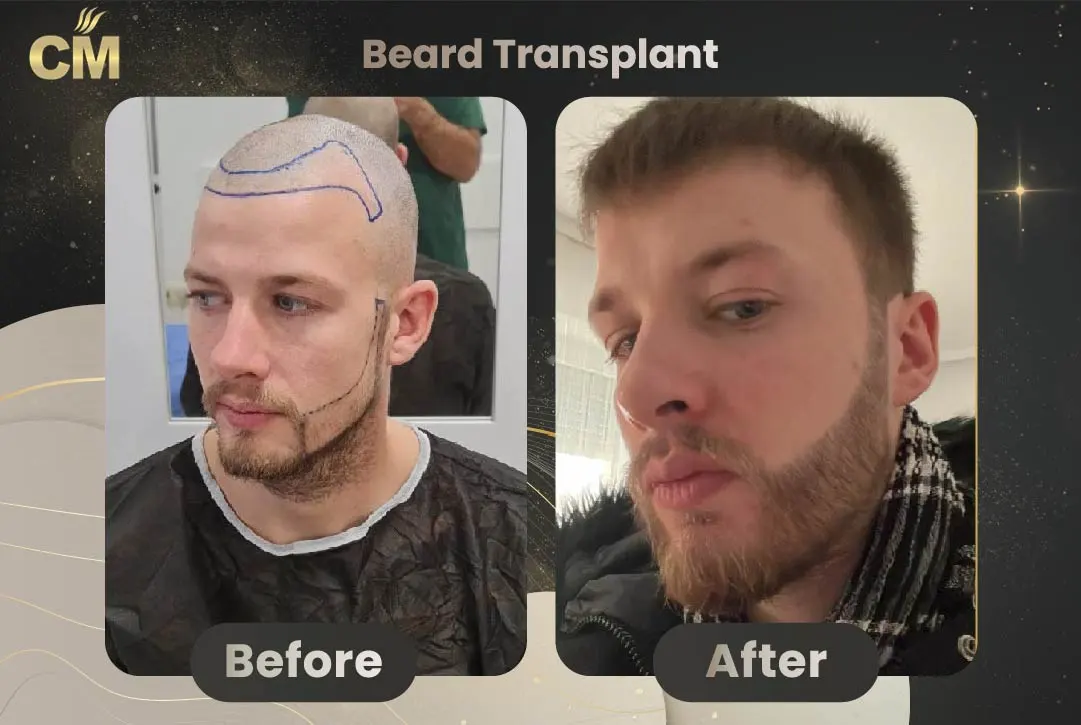 Before and After Result