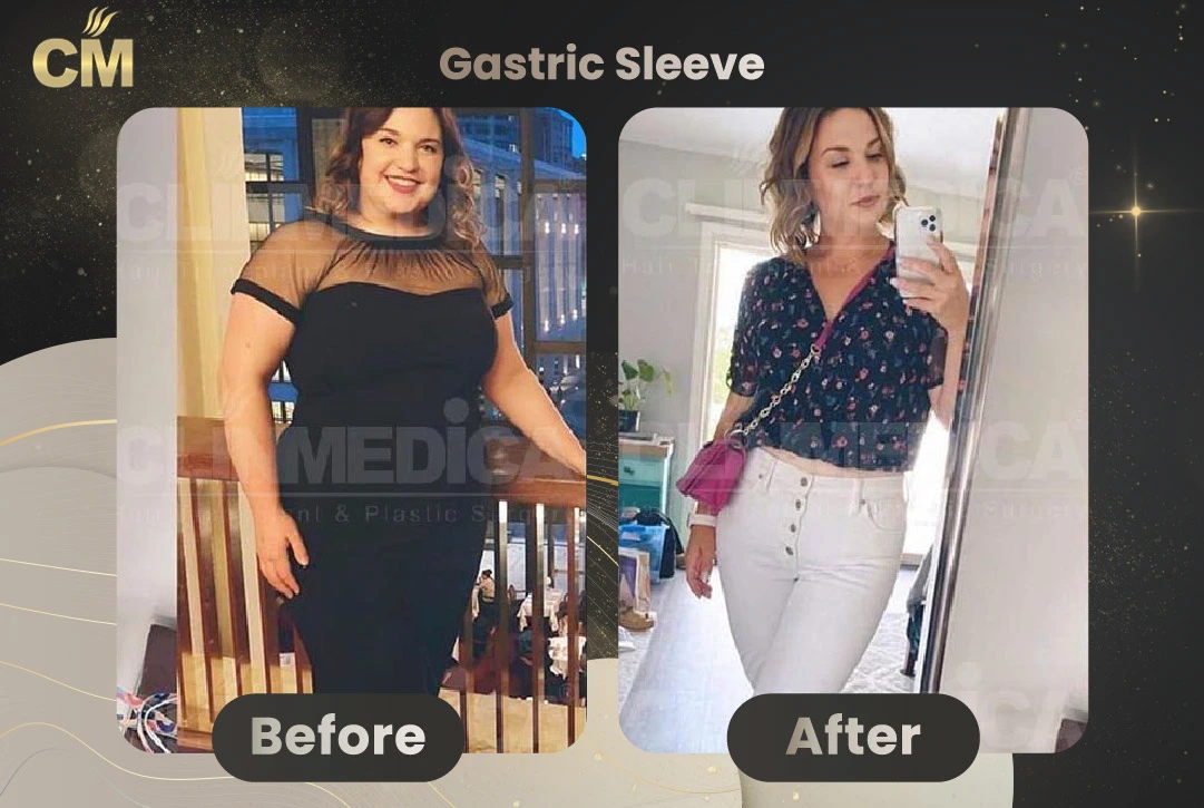 Before and after case 4